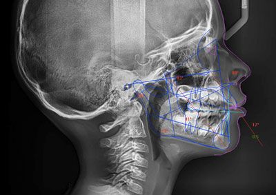 Radio complète d'une mâchoire